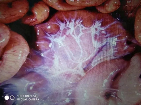 技術控|從部分病理解剖癥狀現(xiàn)場能診斷出是病毒性腹瀉還是細菌性腹瀉